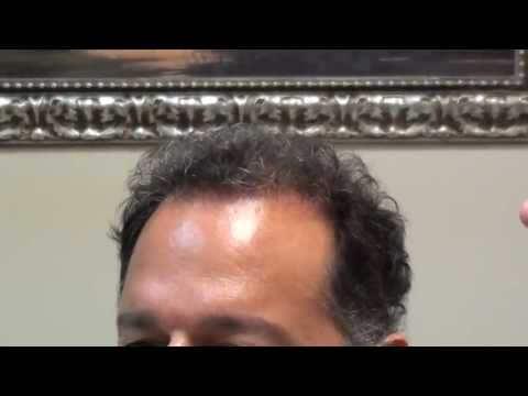 Hair Transplant Video