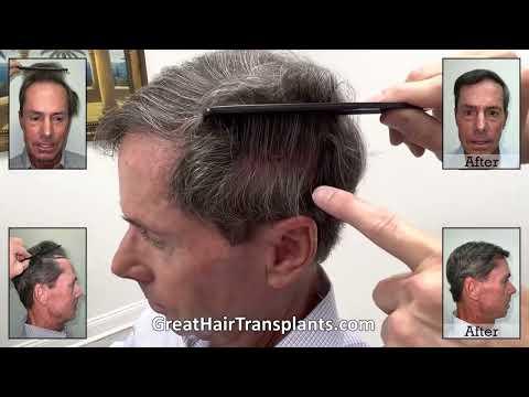 Hair Transplant Video