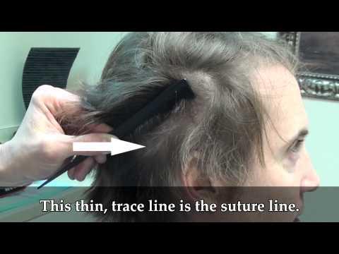 Hair Transplant Video