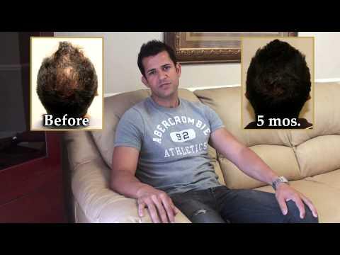 Hair Transplant Video