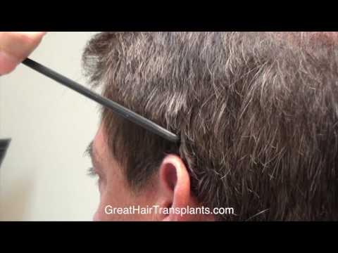 Hair Transplant Videos