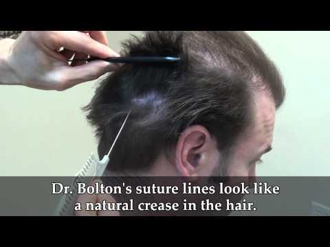 Hair Transplant Video