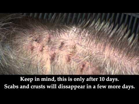 Hair Transplant Videos