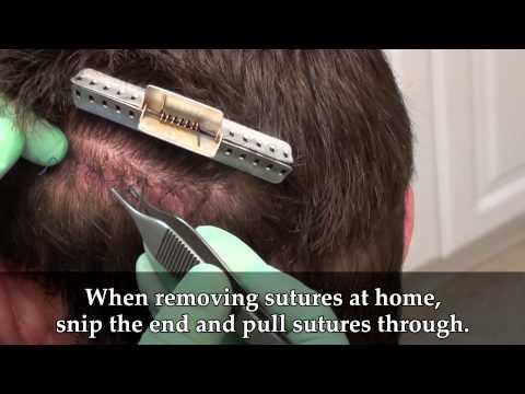 Hair Transplant Videos