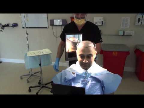 Hair Transplant Video