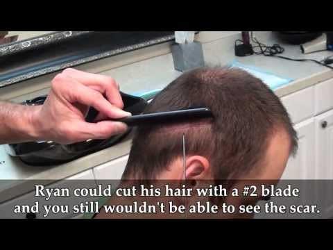 Hair Transplant Videos