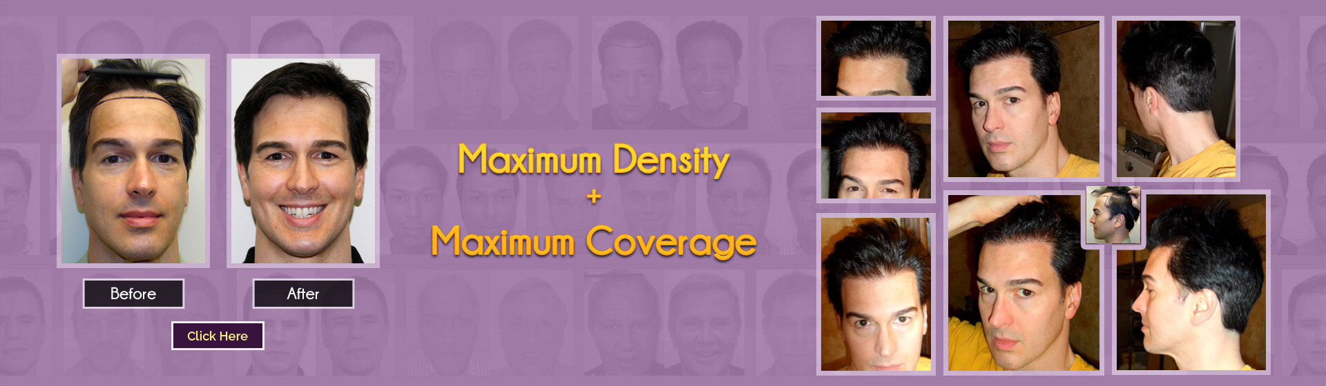 best hair transplant doctors in florida