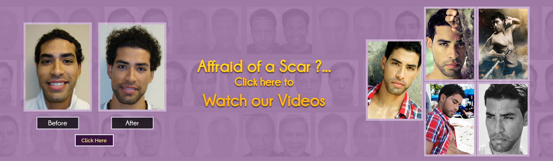 what is hair transplant cost