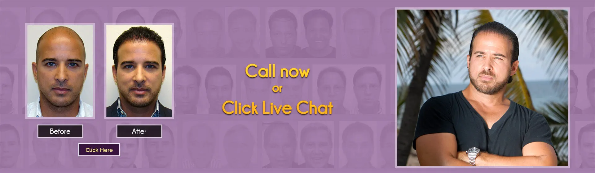 best hair transplant in miami