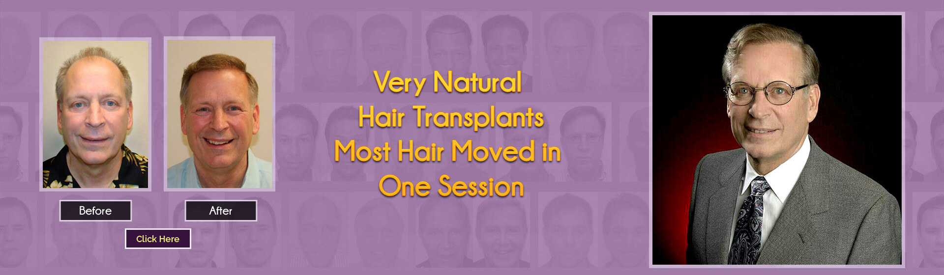 hair club transplant prices