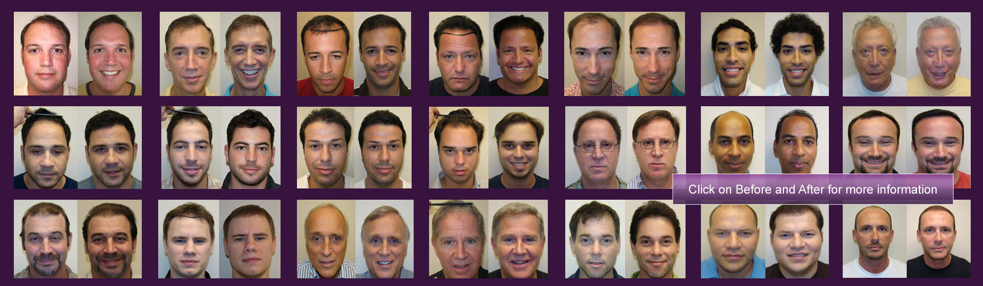 new techniques in hair transplant