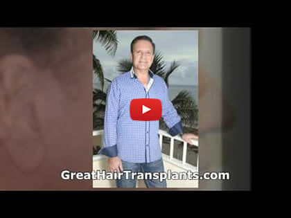 Hair Transplants Video in fort lauderdale , florida