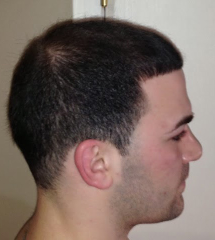 hair transplant photos