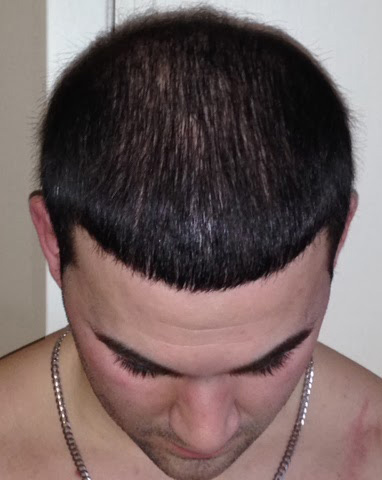 hair transplant photos