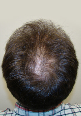 hair transplant before after Photos