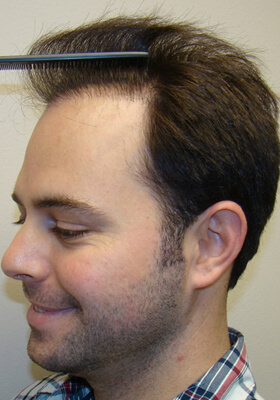 hair transplant before after Photos