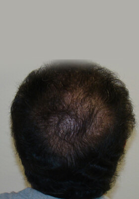 hair transplant photos