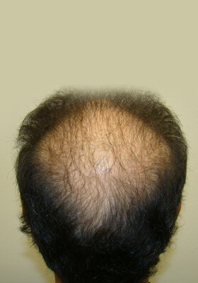 hair transplant photos