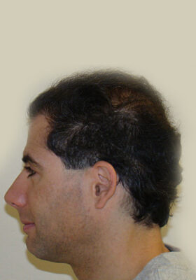 hair transplant before after Photos