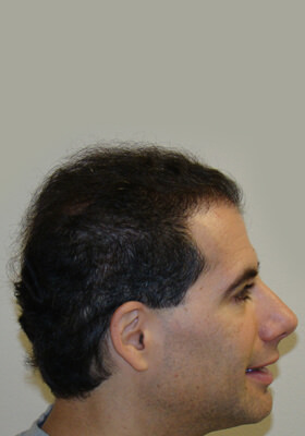 hair transplant before after Photos