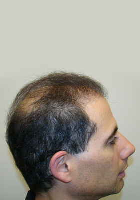 hair transplant before after Photos