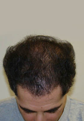 hair transplant before after Photos