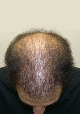 hair transplant photos