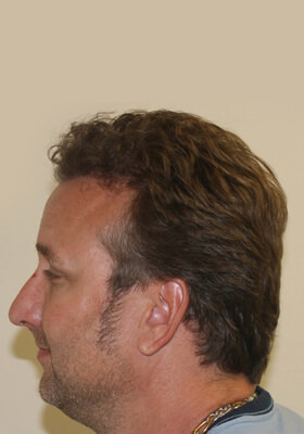 hair transplant photos