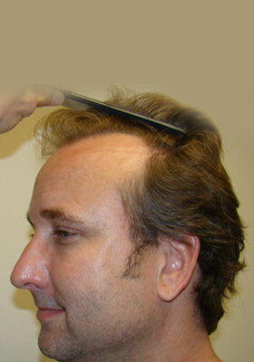 hair transplant photos