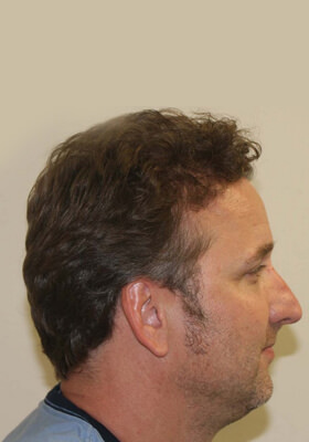 hair transplant photos