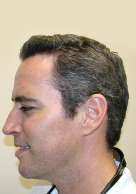 hair transplant photos