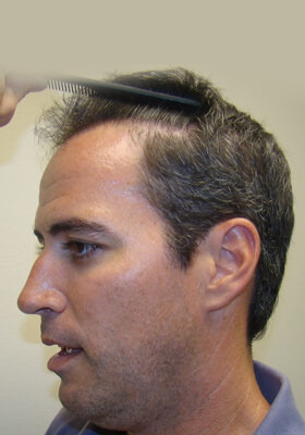 hair transplant photos