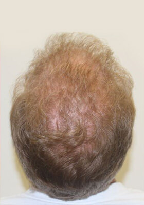 hair transplant before after Photos