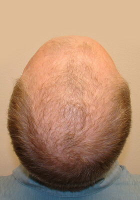 hair transplant before after Photos