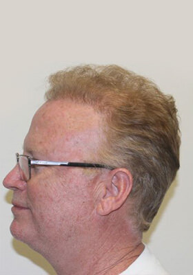 hair transplant photos