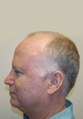 hair transplant before after Photos