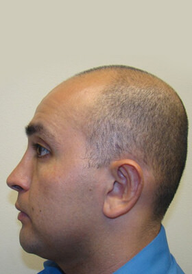 hair transplant before after Photos