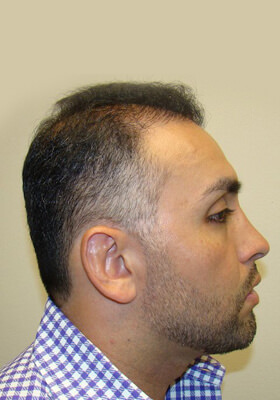 hair transplant before after Photos
