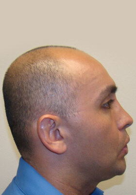 hair transplant before after Photos