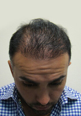 hair transplant photos