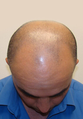 hair transplant photos