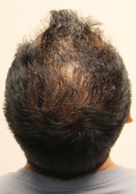 hair transplant photos