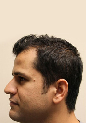 hair transplant photos