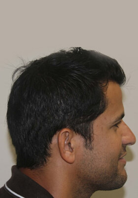 hair transplant before after Photos