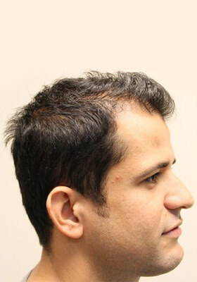 hair transplant before after Photos