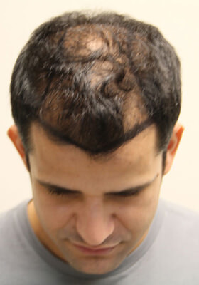 hair transplant photos