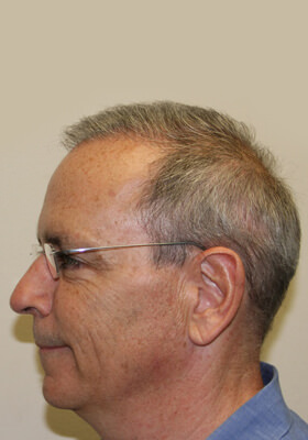 hair transplant photos