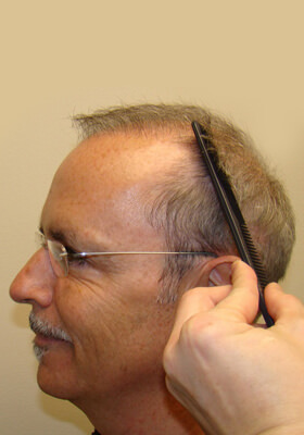 hair transplant photos