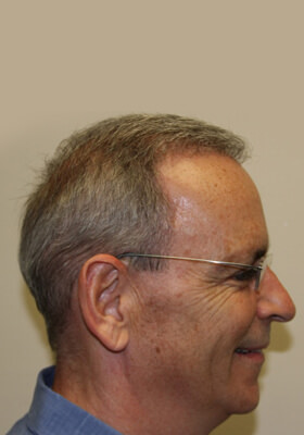 hair transplant photos