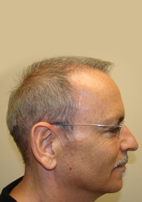 hair transplant before after Photos